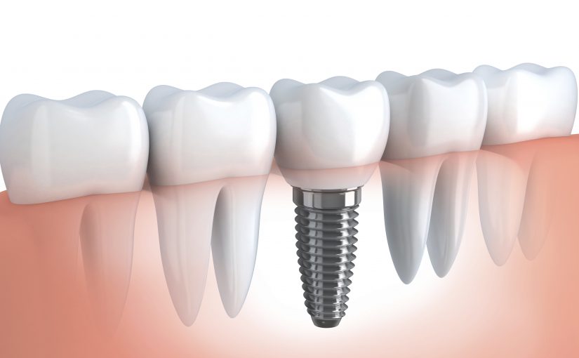 Dental Implants Newark