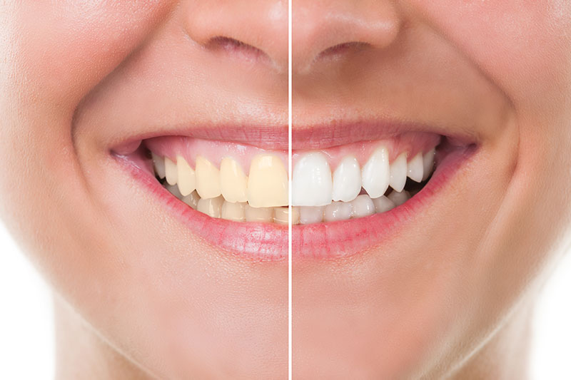 Teeth Whitening - Eternal Dental Care, Newark Dentist